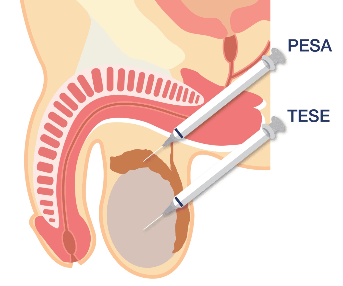 PESA/TESE精子提取技术